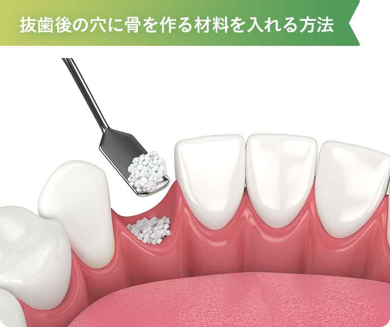抜歯後の穴に骨を作る材料を入れる方法